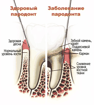 признаки пародонта, пародонтит